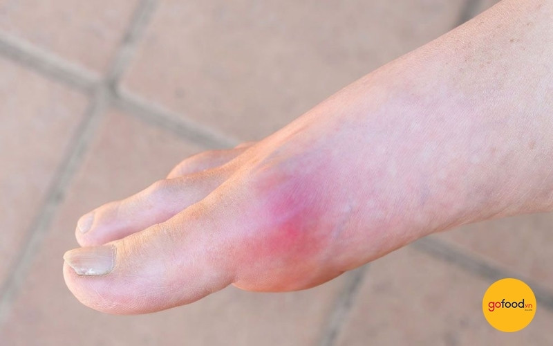 an-qua-nhieu-thit-bo-co-the-gay-ra-benh-gout
